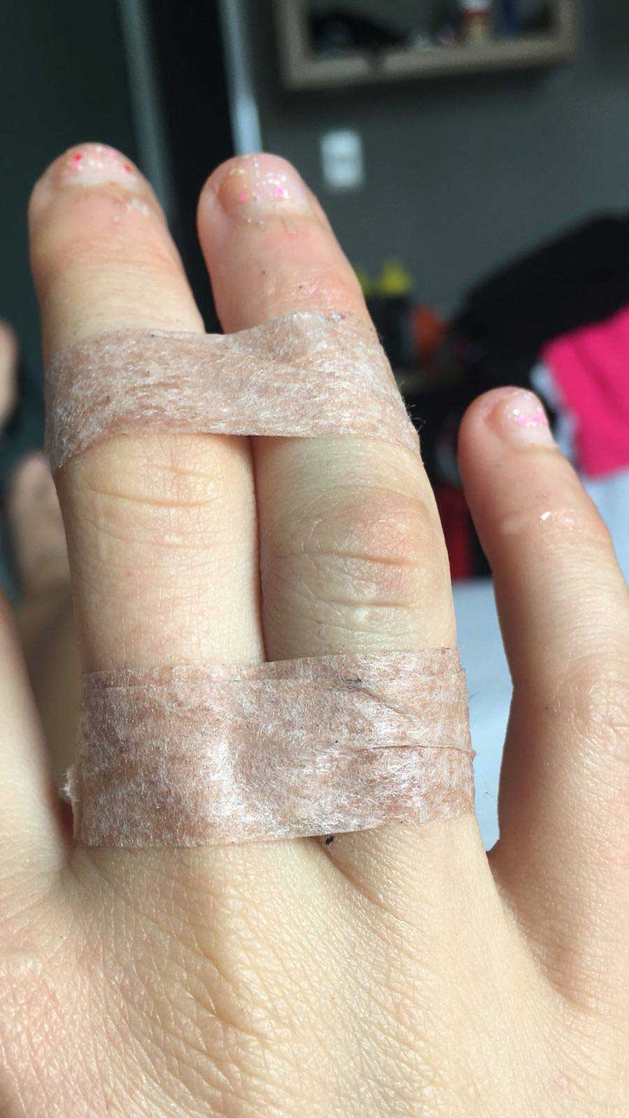 Hauser bricht sich bei Sturz Finger 1