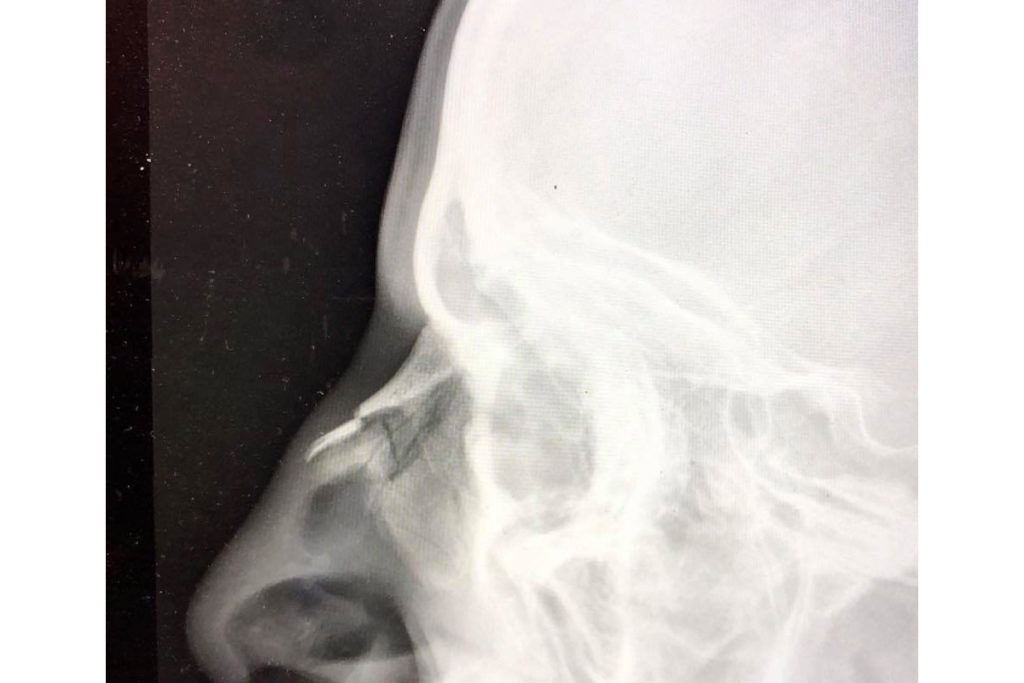 Lukas Hollaus mit gebrochener Nase